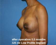 plastic-surgery-breast-augmentation